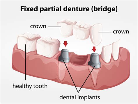Fixed partial denture bridge 303997 Vector Art at Vecteezy