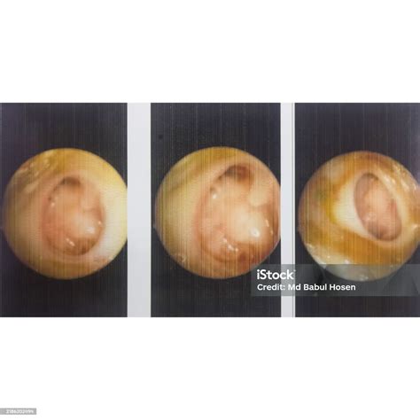 Ear Endoscopy Chronic Suppurative Otitis Media Subtotal Perforation Of ...