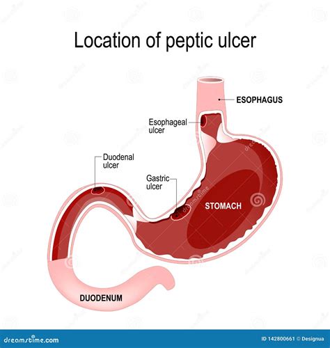 Gastric Ulcer