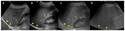 Non-Invasive Imaging Methods to Evaluate Non-Alcoholic Fatty Liver ...