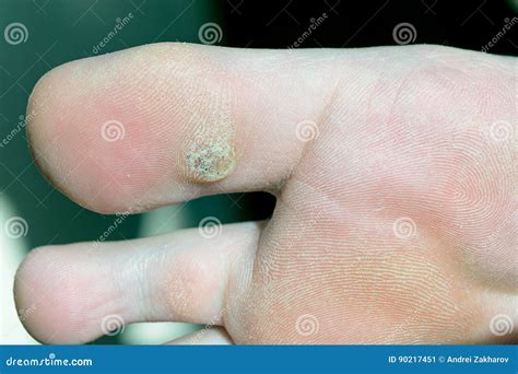 Plantar Wart on Big Toe. Visible Black Dots Warts Stock Image - Image of bone, feet: 90217451