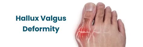 Hallux Valgus: Causes, Symptoms, and Prevention