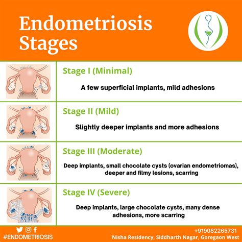 how much is a laparoscopy for endometriosis