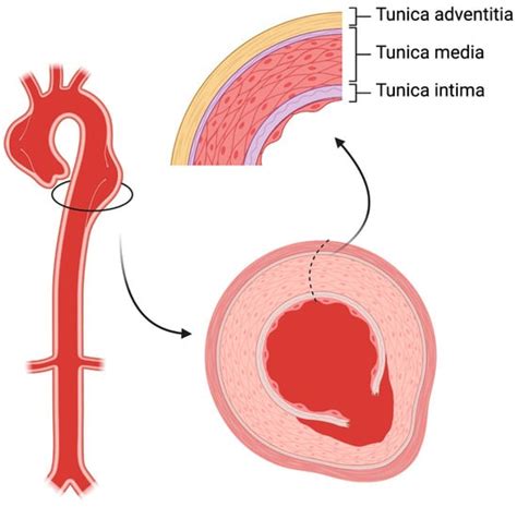 Current Understanding of Aortic Dissection