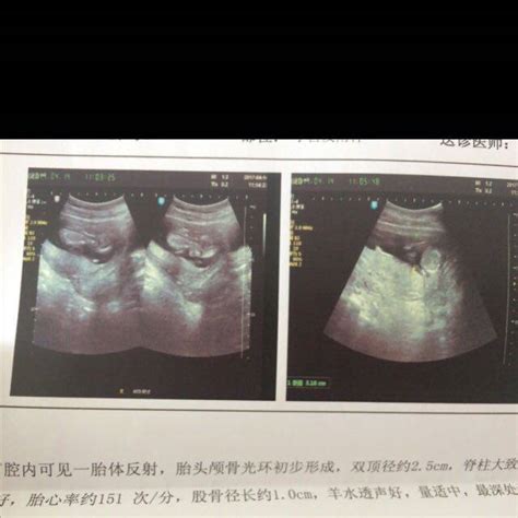 怀孕三个月肚子右侧左侧痛 - 百度宝宝知道