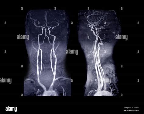 MRA Brain and neck or Magnetic resonance angiography ( MRA ) of ...