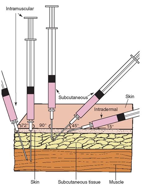 Injection Needle Sizes 的图像结果