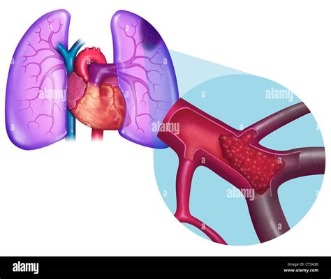 PULMONARY EMBOLISM, DRAWING Stock Photo - Alamy