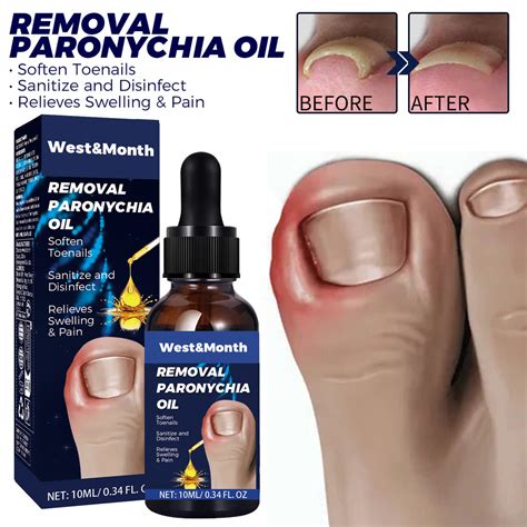 Anti Paronychia Relief Oil Ingrown Toenail Anti Fungal Toe Nail Ingrown Corrector Stop Pain ...
