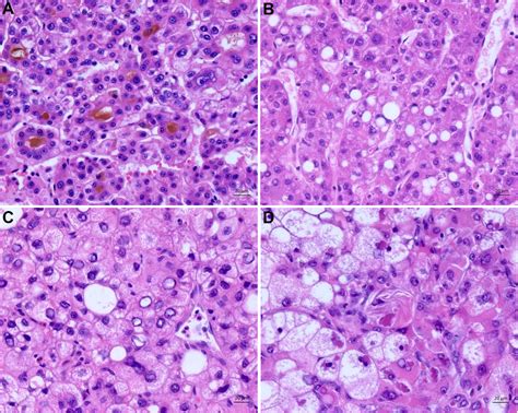 Histopathology of hepatocellular carcinoma - when and what