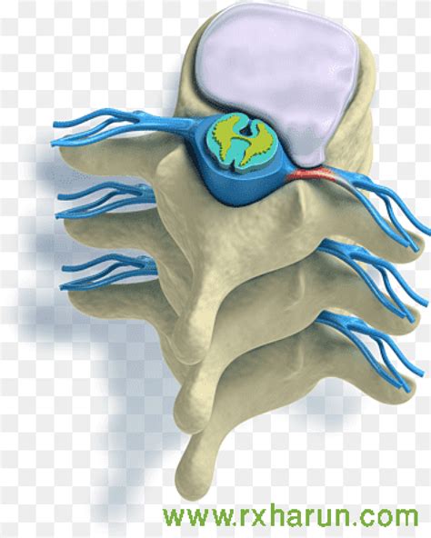 Image result for Foraminal Disc Extrusion