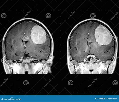 Brain Tumor Pictures Mri
