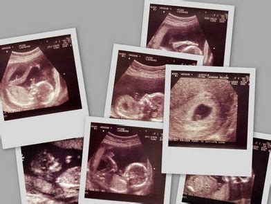 怀孕初期B超胎儿形态解析