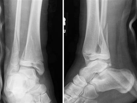 OrthoKids - Ankle Fractures