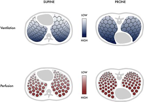 Prone Positioning for Acute Hypoxemic Respiratory Failure and ARDS - CHEST