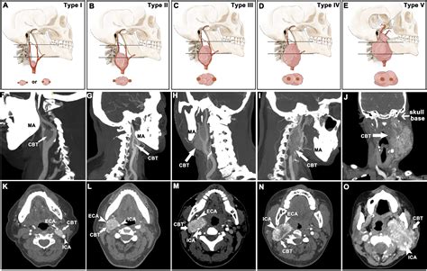 Proposed modification to the Shamblin's classification of carotid body tumors: A single-center ...