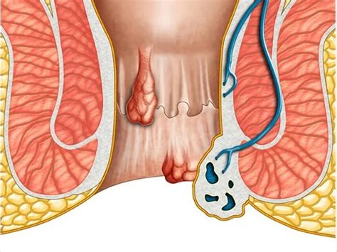 fistula ka ilaj : fistula भगंदर में इस जगह तकिया लगाकर बैठने से नहीं ...