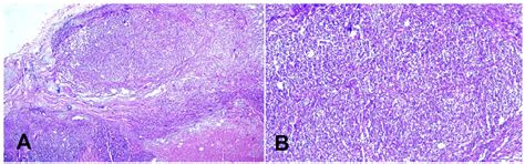 Sebaceous cell carcinoma of the scalp in a young male: A rare case ...