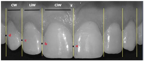 Golden Mean and Proportion in Dental Esthetics after Orthodontic Treatments: An In Vivo Study
