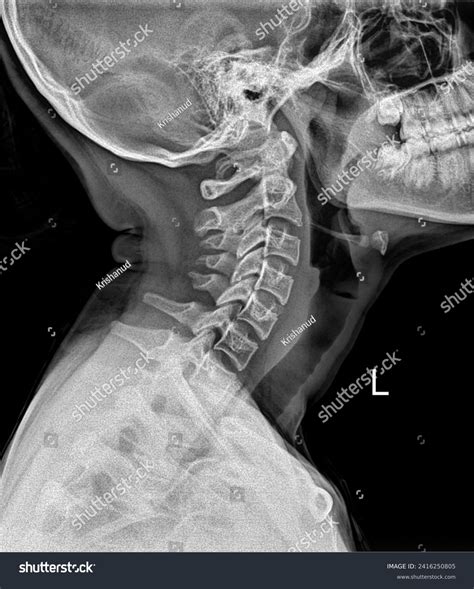 X-ray Neck Cervical Spine Side View Stock Photo 2416250805 | Shutterstock - neck x ray