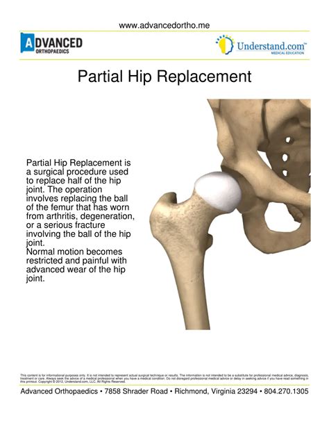 What Is A Partial Hip Replacement Surgery at Madeleine Darbyshire blog