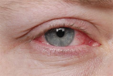 How Long Is Pink Eye Contagious?