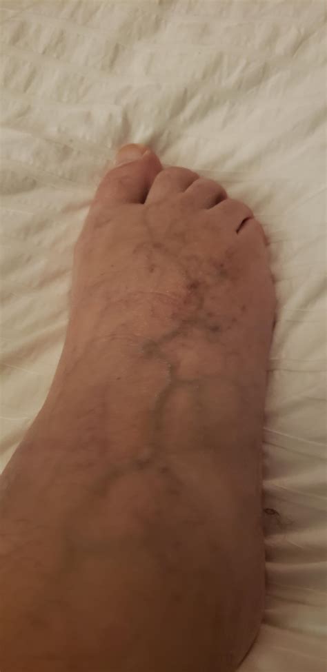 Blood Pooling Pots Syndrome Feet at Imogen Andrade blog