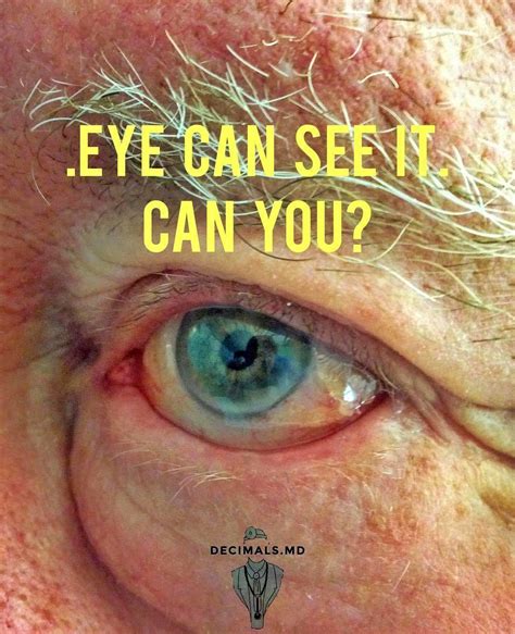 Bildergebnis für blurred vision after blepharoplasty