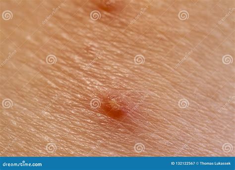 Close Up of Molluscum Contagiosum Also Called Water Wart Stock Image ...