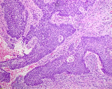 Is Squamous Cell Carcinoma Lung Cancer - Infoupdate.org