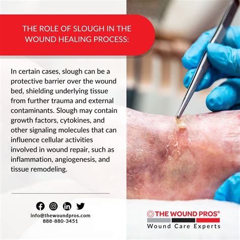 How slough affects wound healing | Wound Pros Management Group, Inc ...