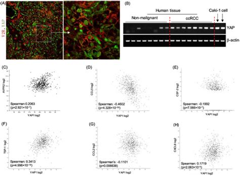 Vasopressin Receptor Type-2 Mediated Signaling in Renal Cell Carcinoma ...