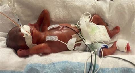 Infant breaks world record as most premature baby to survive