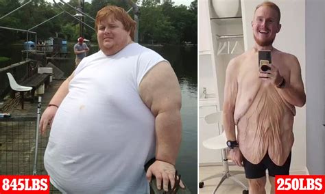 Super Morbidly Obese Before And After