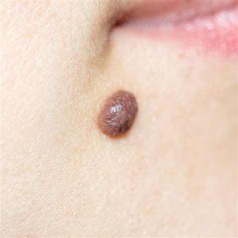 Skin Mole Removal At Home