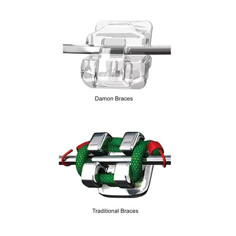 Damon Braces Surbiton | Advanced Fixed Braces Dentist Kingston Surrey