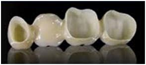 Dental Clinic | Crowns & Bridges