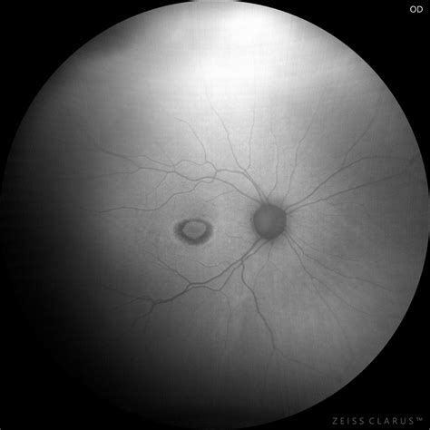 Bull’s eye maculopathy related to antimalarial drugs – Retinography