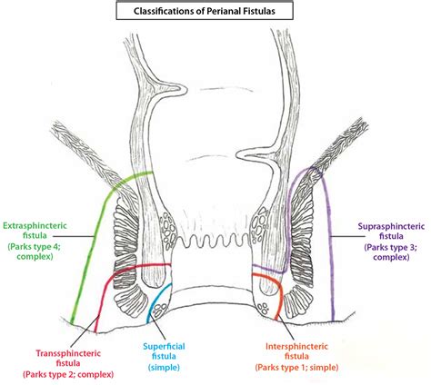 Perianal fistula causes, symptoms, diagnosis, treatment & surgery