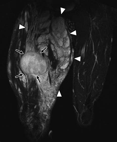 MRI Features in the Differentiation of Malignant Peripheral Nerve Sheath Tumors and ...