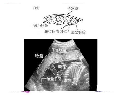 胎盘成熟度临床分级|胎盘成熟度几级才能生？胎盘分级的临床意义介绍_安贝乐育婴网