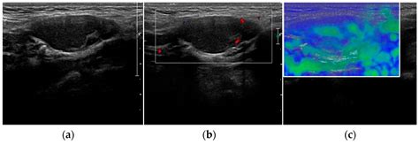 The Dark Side of Ultrasound Imaging in Parathyroid Disease