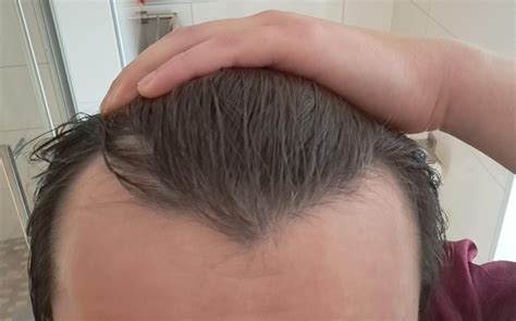 M Shape Hairline