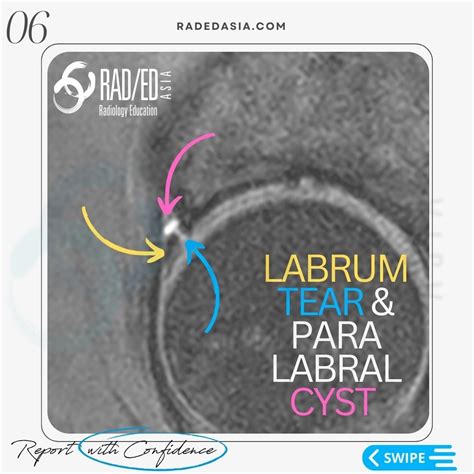 HIP LABRUM LABRAL TEAR MRI RADIOLOGY - Radiology Education Asia