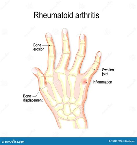 Hand with Rheumatoid Arthritis Stock Vector - Illustration of anatomy, inflammation: 138232230