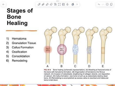 Bone stages of healing Flashcards | Quizlet