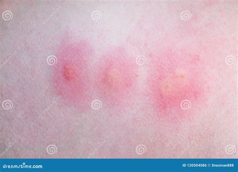 Mosquito Bite To the Foot. Inflammation Stock Photo - Image of bite, human: 120504086