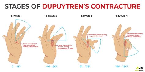 Dupuytren's Contracture | Do Your Fingers Cramp, Curve or Curl up?