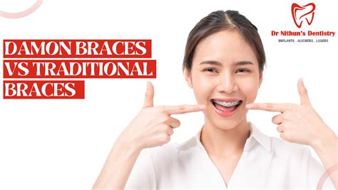 Damon Braces vs. Traditional Braces: Which is the Better Choice?