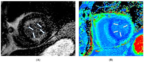 Cardiovascular Magnetic Resonance Imaging Patterns in Rare ...